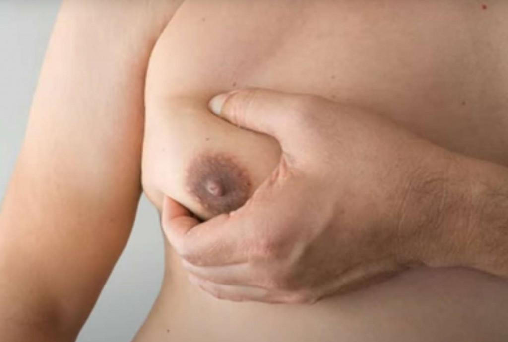 pseudoginecomastia o grasa en el pecho del hombre 