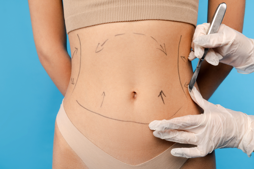 lipoescultura-que-es