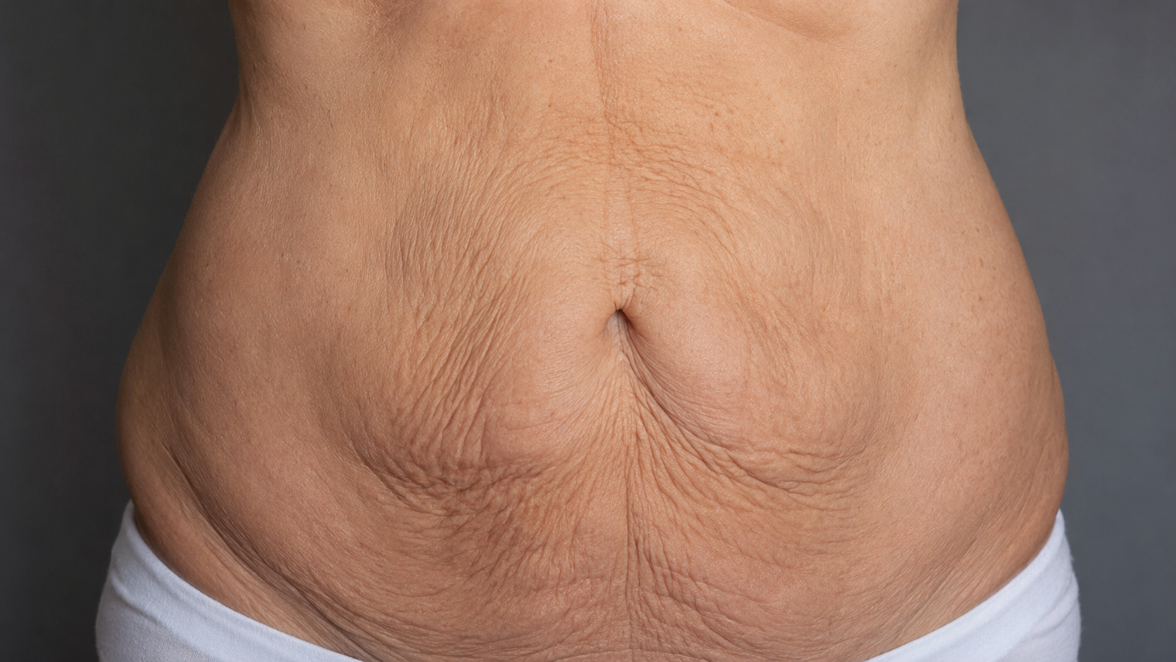 flacidez abdominal tratamientos